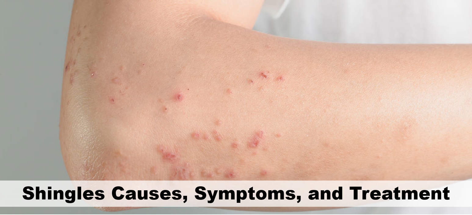 Shingles Causes, Symptoms, and Treatment